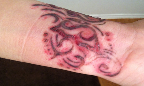 Allergic reaction to red tattoo ink 