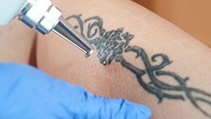 How to Remove Fresh Tattoo Ink From Skin